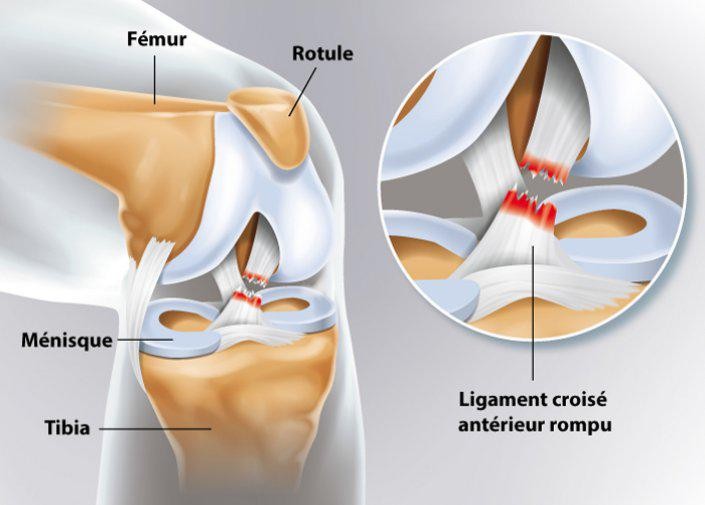 blessures ligamentaires