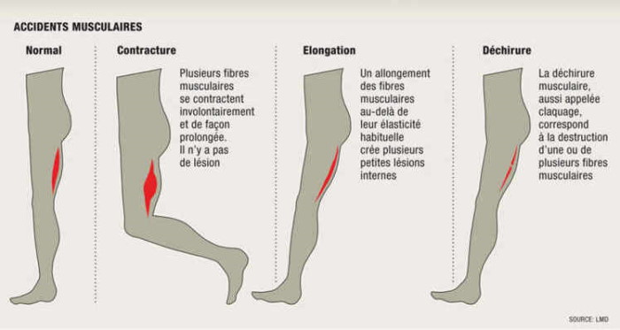 Les blessures musculaires